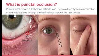 Punctal Occlusion [upl. by Kwon]