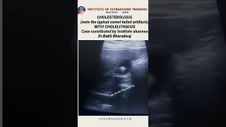 Cholesterolosis with cholelithiasis ultrasound ultrasoundlife pocus [upl. by Eeb448]