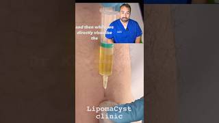 Bakers Cyst drainage under ultrasound [upl. by Airehc]