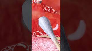 ASMR Zombie oral treatmentoral stones stomatitis tonsillitis treatment animation asmr좀비 압안결석치료 [upl. by Bonnie569]