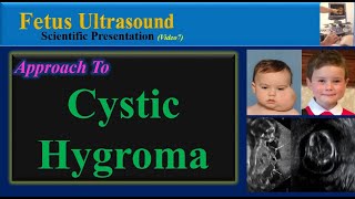 Fetus Ultrasound Cystic Hygroma [upl. by Ynej417]