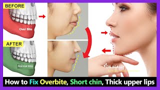 7 Steps How to Fix Overbite small chin big thick upper lip without braces naturally [upl. by Marra]