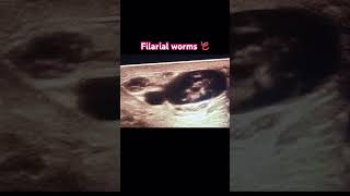 Filarial worms radiology ultrasonography medicine clinical [upl. by Morris129]