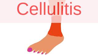 What is Cellulitis  Pathology mini tutorials [upl. by Darcie]