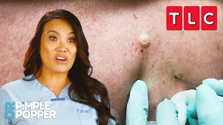 The BEST Blackhead Pops  Dr Pimple Popper  TLC [upl. by Mercier]