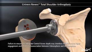 Univers Revers™ Total Shoulder Arthroplasty [upl. by Odnomra]