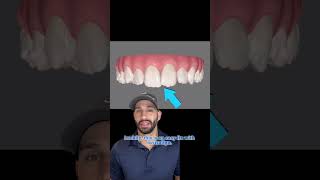 Invisalign treatment to straighten overlapped and crooked front teeth [upl. by Rima]