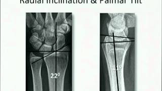 Distal Radius fracture [upl. by Broderic]