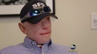 SeverelyBurned Former Firefighter Opts for Face Transplant Part 1  ABC News [upl. by Reid]