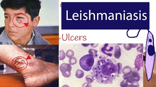 Leishmaniasis  Symptoms and Treatment of Leishmaniasis Explained under 3 minutes [upl. by Nauqyt]