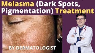 Melasma Treatment  Dark Spots Pigmentation Treatment  Dr Sunil Kothiwala  Dermatologist [upl. by Clara]