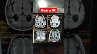 Gliosis on MRI shorts youtubeshorts shortsvideo [upl. by Tomkins]