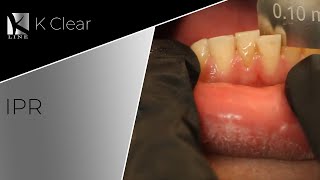 Interproximal ReductionsTeeth Strippingreshaping in Clear Aligners Treatment [upl. by Laehplar685]