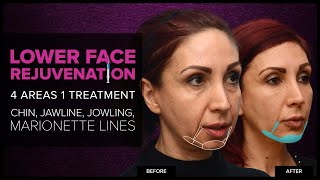 Lower Face Rejuvenation Chin Jawline amp Jowls With Dermal Fillers at Mabrie Facial Institute [upl. by Lairbag]