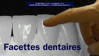 Facettes dentaires  No 15 etapes  Dr Éric Hazan Paris 16 [upl. by Ern689]