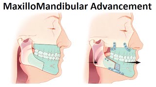 Surgical Treatment of Retruded Jaws MaxilloMandibular Advancement Surgery by Dr Mike Mew [upl. by Fricke]