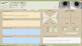 eVNG Caloric Test Demo [upl. by Piks]