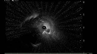 Cone beam CT guided Biopsy [upl. by Wolsky]