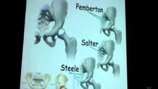 Osteotomies Around Hip Prof Dr Khaled Emara [upl. by Georglana679]