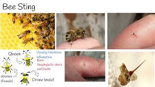 Bee sting  How to treat a bee sting [upl. by Akimak]