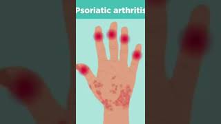 Psoriatic arthritis rheumatology psoriasis ytshort ytytshorts [upl. by Aiet477]