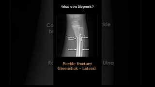 Buckle fracture Greenstick Lateral 128Xray Upper limb gallery1 Greenstickradiologychannel007 [upl. by Fai]