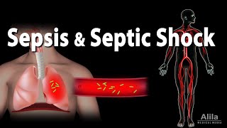 Sepsis and Septic Shock Animation [upl. by Maxine]