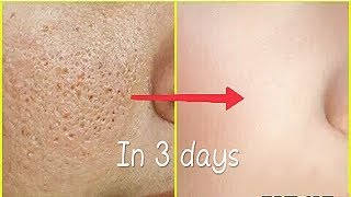 Remove Face holes fast naturally  get clear skin naturally  hole less skin [upl. by Sardella]