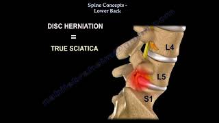 Low Back pain Lumbar disc herniation causes diagnosis symptoms and treatment [upl. by Ogata538]