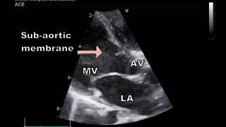 Tips and tricks of VSD echocardiography Ventricular Septal Defect [upl. by Nedroj97]