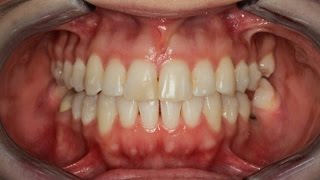 Invisalign Time Lapse [upl. by Nonregla826]