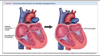 Paradoxical embolism pathology mbbs [upl. by Lazes234]