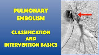 PE Classification amp Intervention Basics [upl. by Elyagiba262]