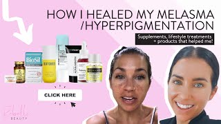 How I Healed My MelasmaHyperpigmentation 2021 Updates Products Supplements and Treatments [upl. by Cayla]