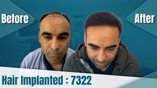 Best Hair Transplant In DelhiNCR 😎  Hair Transplant Cost In Delhi  DHI™ India [upl. by Inor]