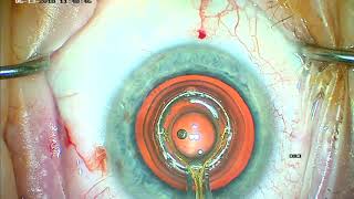 Zepto Precision Pulse Capsulotomy during Cataract Surgery [upl. by Ylimme251]