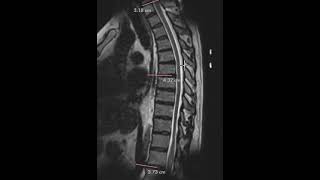 Thoracic disc herniation and epidural lipomatosis [upl. by Bourque]