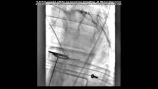 Case report PCI during cardiac arrest  Supplementary video 1 57953 [upl. by Swor]