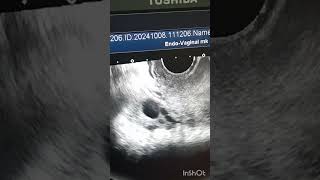 Ultrasound of Ovary with dominant follicle pregnant tryingtoconceive ovar infertilty [upl. by Grube858]