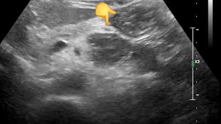 Diagnostic dilemma Pancreatic Lesion Jejunal Loop Mimicking Cancer on Ultrasound – CT Clarifies [upl. by Grunberg]