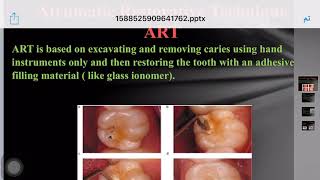 Atraumatic Restorative Treatment 5th stage [upl. by Esinev528]