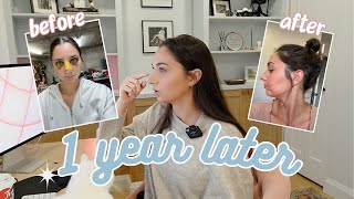 The Truth About My Rhinoplasty 1 year later [upl. by Lisk]