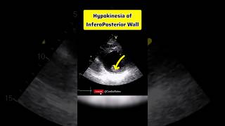 Hypokinetic InferoPosterior Wall anatomy heartphysiology heart echocardiagram [upl. by Ahsinet]