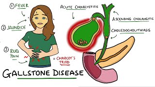 Gallstone Disease  Acute Cholecystitis vs Cholelithiasis vs Choledocholithiasis vs Cholangitis [upl. by Ellehsat]