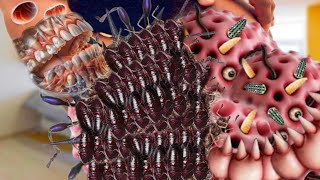 ASMR removal maggots infected back side  ASMR shoulder treatment animation Deep Cleaning Animation [upl. by Ten463]