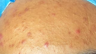 Extraction boutons pimples et acné kystique cystic acne sur le front [upl. by Celtic]