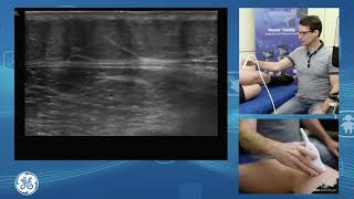 Sonographic assessment of the lateral knee for POCUS clinicians [upl. by Ahsikram]