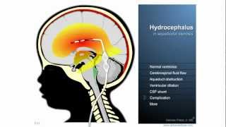 Hydrocephalus  Definition treatment and complications [upl. by Inasah]