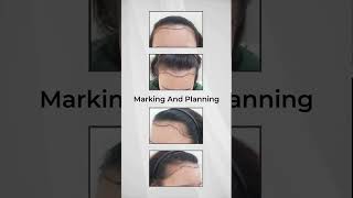 AESTHETIC CLINIC MALAYSIA  Hairline Transplant Witness the Transformation [upl. by Nnarefinnej]