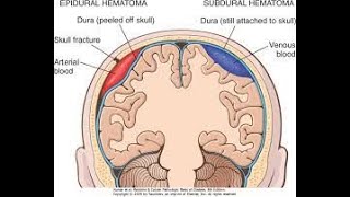 Meningeal Layers amp Extradural Hematoma [upl. by Miche]